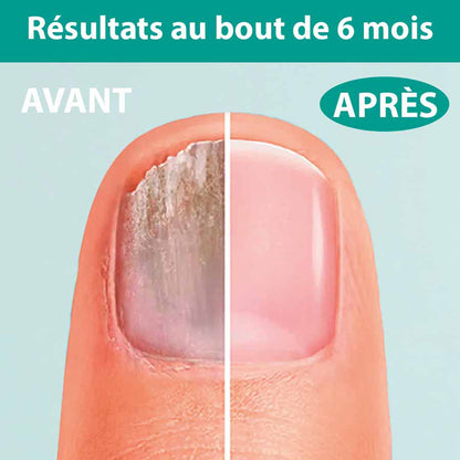 Traitement Mycose De L Ongle Sephorris MARLAY